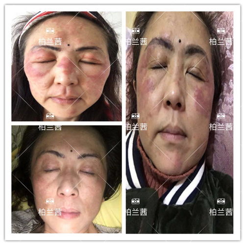  从毁容烂脸到整容修复只差ta